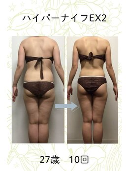 ベルシア 吉祥寺店(BELCIA)/ハイパーナイフEX2/ダイエット