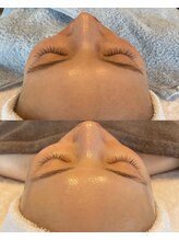 ソイル(Soil)/ワイコ水光ピール　Winona