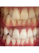 シエル(CIEL)/医療提携セルフホワイトニング