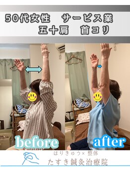 たすき鍼灸院 浦和/50代女性五十肩　首コリ