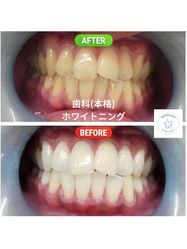 グロウ 東区香椎(GLOW)/歯科(本格)ホワイトニング