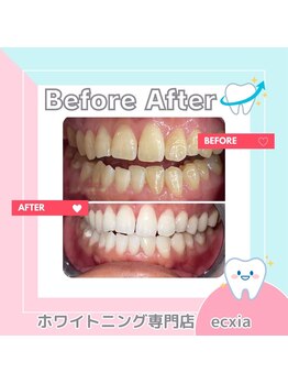 エクシアホワイトニング 札幌琴似店/ビフォーアフター