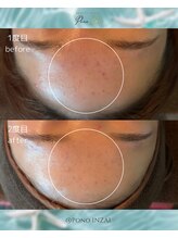 ポノ(Pono)/2回目のBefore/After☆