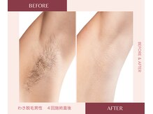 ウェルネス ステーション リンク(Wellness Station Link)/わき脱毛