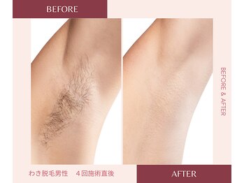 ウェルネス ステーション リンク(Wellness Station Link)/わき脱毛