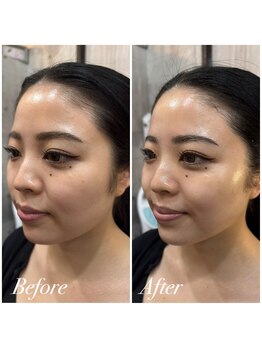 ミランオオサカ(MIRAN OSAKA)/オンダリフト級小顔