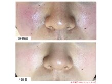 ウェルビーイング(well-being)の雰囲気（韓国肌管理　最新マシンでの毛穴洗浄ヘッドスパ付き）