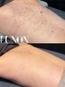 【BODY☆背中全体ニキビケア】ハーブピーリングで根本改善◎リアクションあり