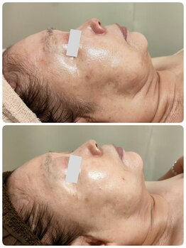 庭夢エステの写真/50代からのたるみ、ほうれい線の目立ち、シワ(目元、首、額)シミを改善◆鏡を見るのが楽しくなる毎日へ♪