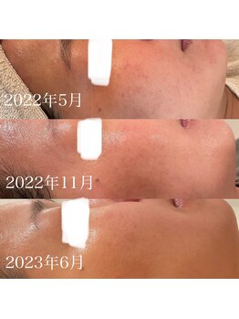 ポポラス(POPOLUS)/肌質改善コース　1年継続