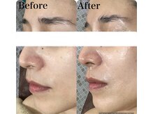 マスカレード(Masquerade)/【クリスティーナ症例写真】