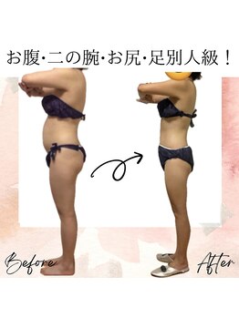 サロン ド ボーテ ラーンジュ 岐阜店(salon de beaut'e L'ange)/ハイパ-ナイフEX2ダイエット痩身