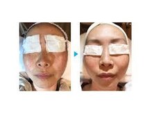 アムール(Amour)/フォト光フェイシャル6,600円