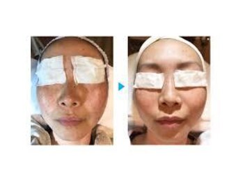 アムール(Amour)/フォト光フェイシャル6,600円