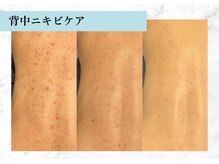 リメイク 銀座(REMAKE)/幹細胞ゴールドピーリングボディ