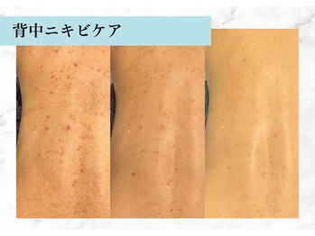 リメイク 銀座(REMAKE)/幹細胞ゴールドピーリングボディ