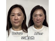 コルミチョン サロン(骨美整 salon)/50代女性　Before・After