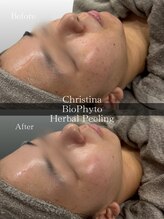 クレビア(CREBIA)/ニキビや跡にも効果絶大