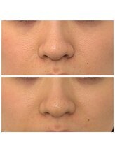 イーオ(io)/水光肌ピーリング3回