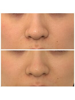 イーオ(io)/水光肌ピーリング3回