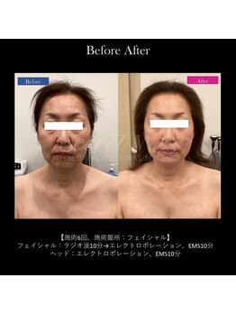 ドルチェビューティーサロン 戸塚安行店(Dolce Beauty Salon)/エイジングケアFacial_施術6回