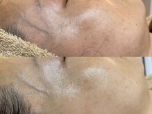 ブラン ネージュ(Blanc Neige)/マーメイドセルトリートメント