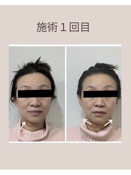 ミヤビ(miyabi)/小顔矯正