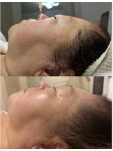 リフテグレース(LIFTE Grace)/二重顎撃退