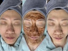 イーヴ(Eave)/【肌質改善】カカオピーリング