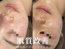 肌質改善専門【Salon da Mahina】毛穴ケア/ニキビケア/ハーブピーリング