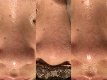 サロン ラズリ 久留米店(SALON Lazuli)/【毛穴洗浄】脂性肌やニキビに◎