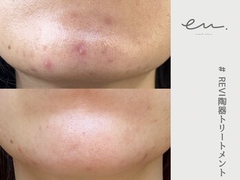 エム(eM.)/REVI陶肌トリートメント3回施術