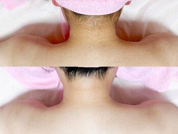 ライトウェーブ 松本村井本店/うなじ～えり足～背中 Set脱毛