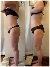 エムティーサロン(Mtsalon)/２ヶ月モニター結果！