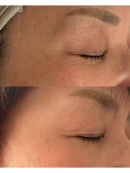 彌庵/乾燥小じわ改善　症例