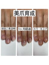 マニュコクーン(ManuCocoon)/爪育成　深爪　巻き爪　大阪市