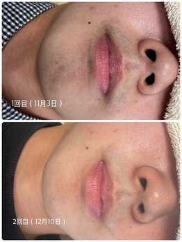 ドゥ(doux)/当店のお髭脱毛♪