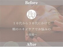 ハーバリー ハーブピーリング 大阪梅田店(HERBERRYハーブピーリング)/梅田ハーブピーリングHERBERRY