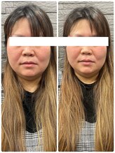 長寿鍼灸院 長寿整骨院/美容鍼25本の効果★小顔効果