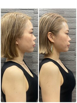 長寿鍼灸院 長寿整骨院/美容鍼50本の効果★小顔効果