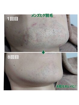 ルアナ(Luana)/メンズヒゲ脱毛♪