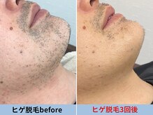 ミスターアンクール 鹿児島(Mr.uncoeur)/ヒゲ脱毛3回後