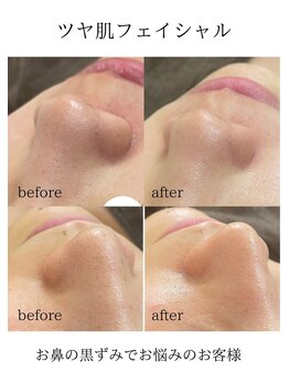 リニューサロン 本院(renew salon)/☆毛穴ケア☆