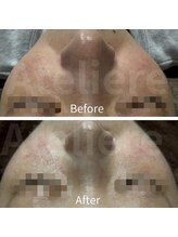 アトリエール(Ateliere)/ハイドラプラズマでしみしわ改善