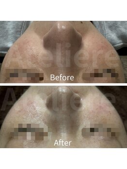 アトリエール(Ateliere)/ハイドラプラズマでしみしわ改善