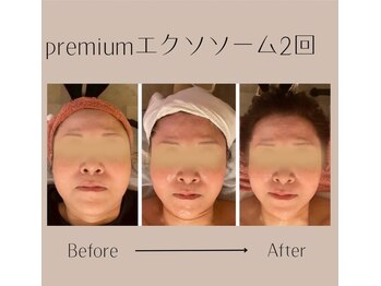 ナナイロ(nanairo)/ポテンツァ×エクソソーム