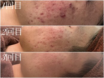 アンドナイン エス店(ANDNINE.)の写真/[”変わる”が実感できるモニタープラン◆ハーブピーリング4回¥33000] 継続ケアで本気の美肌革命を！