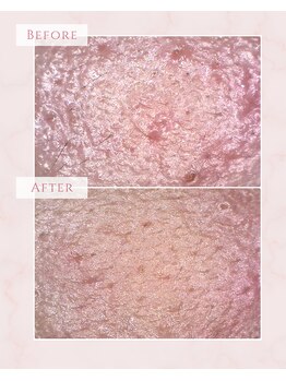 ベベ 福井丸岡店(Be'be')/オーヴル毛穴フェイシャル＋