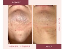 ウェルネス ステーション リンク(Wellness Station Link)/ヒゲ脱毛