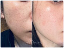 エルール トータルビューティ(Aileure total beauty)/最先端のVOSハーブピーリング